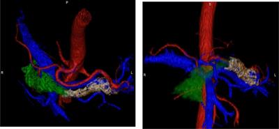 Role of 3D Volumetric and Perfusion Imaging for Detecting Early Changes in Pancreatic Adenocarcinoma